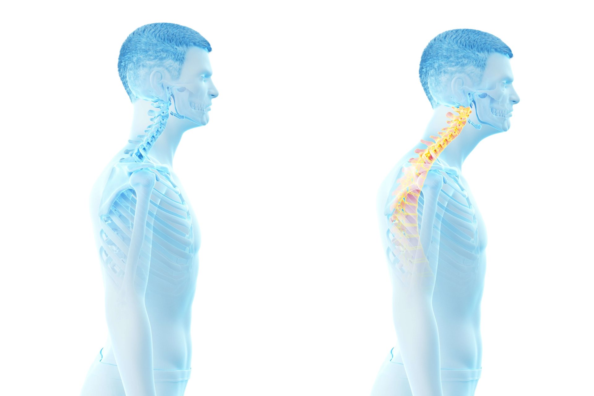 Image for What is Forward Head Posture?