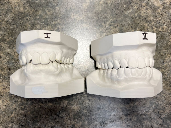 before-and-after-neuromuscular-TMJ-orthotic