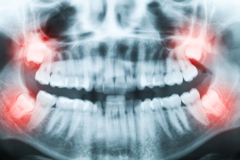 Wisdom Teeth affect TMJ