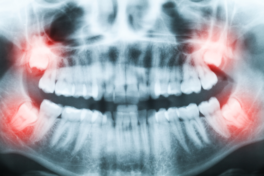 Tooth's x-ray with red spots