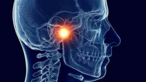 TMJ Dysfunction