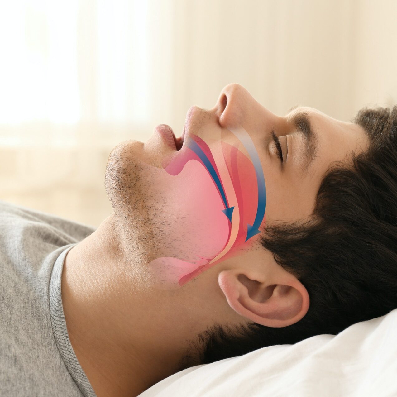 A man with sleep apnea disorder